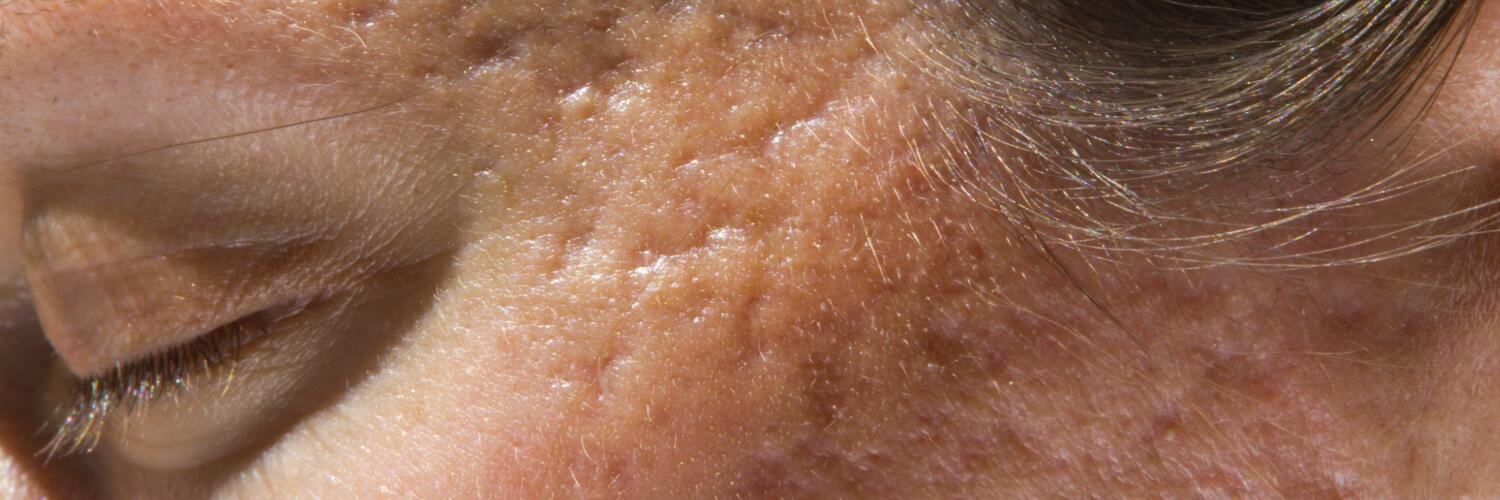 cicatrice atrophique visage